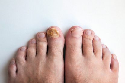 Kojų nagų grybelio nuotraukos