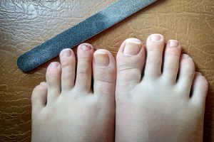 Kojų nagų grybelio simptomai