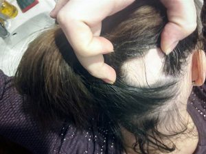 Židininis plaukų slinkimas moterims