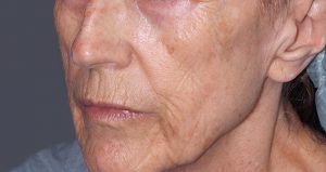 Atoniška oda (odos elastozė)