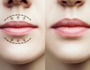 Chirurginė lūpų korekcija (putlinimas, didinimas)