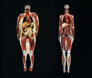 Visceralinių pilvo riebalų nuotrauka